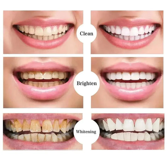 Stylo de blanchiment des dents magiques